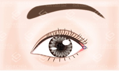 開眼尾手術-骨膜固定
